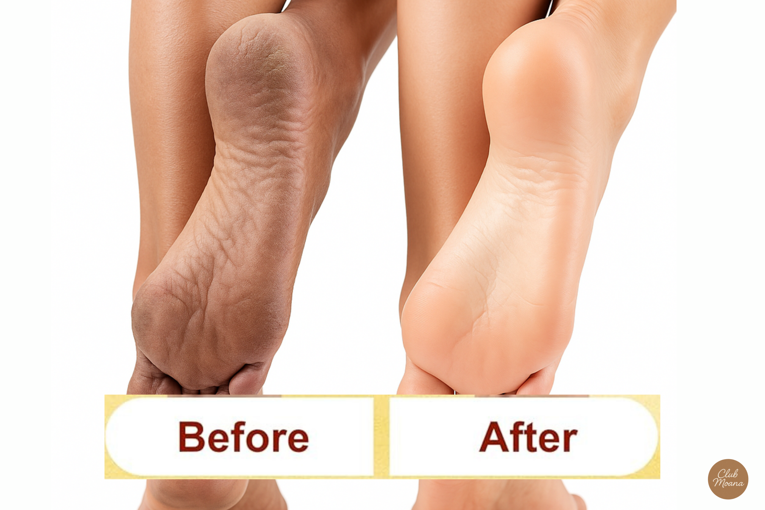 Before and after cracked heels – foot transformation example.