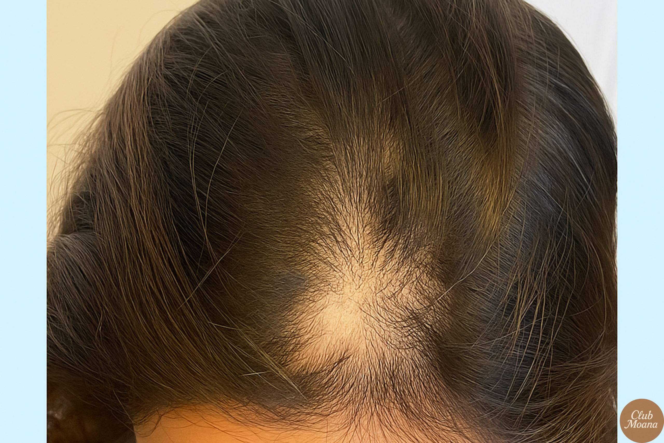 Is It Really Telogen Effluvium? Or Something Else?